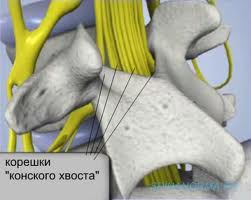 Ущемленный нерв или позвоночника Ущемленный нерв или позвоночника