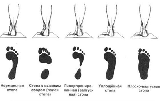 виды-плоскостопия