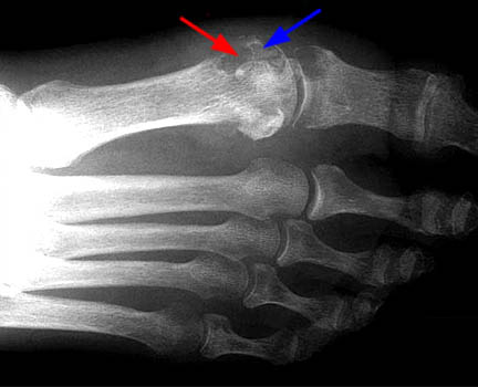 подагрический артрит рентген