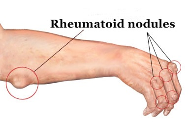 rheumatoid-nodules-sites1