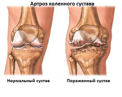 Артрозы коленных суставов виды заболеваний лекарство для восстановления хрящевой ткани в суставах
