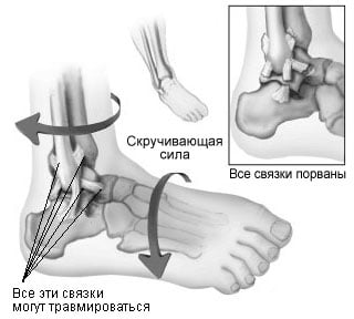 sprained_ankle