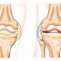 Степени артроза коленного сустава (1, 2, 3 степени)