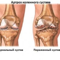 Артроз коленного сустава виды, степени, лечение и профилактика