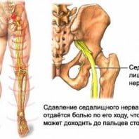 Защемление нерва в пояснице, ноге, спине — симптомы и как лечить