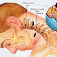 Остеохондроз шейного отдела позвоночника — симптомы, признаки
