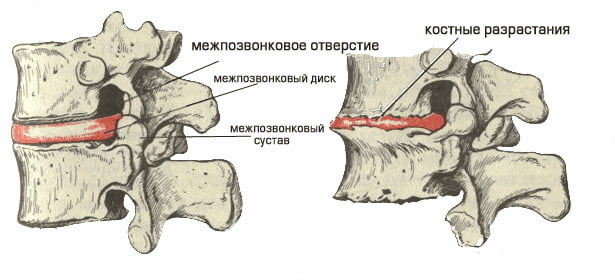 Дистония вертебральных артерий на фоне шейного остеохондроза признаки