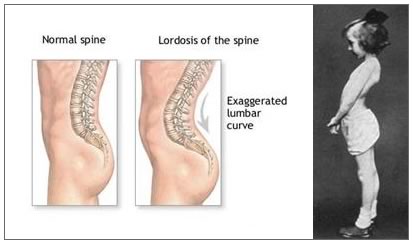 Лордоз и кифоз фото