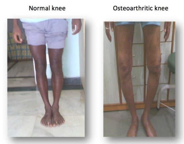 Osteoarthritic-knee