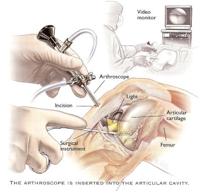 Артроскопия коленного сустава видео, процедура, реабилитация