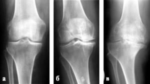 Фото артроза коленного сустава 2 3 степени