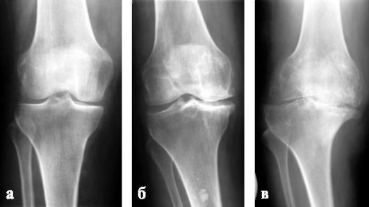 артроз правого коленного сустава: а — I стадия; б — II стадия; в — III стадия — суставная щель резко сужена