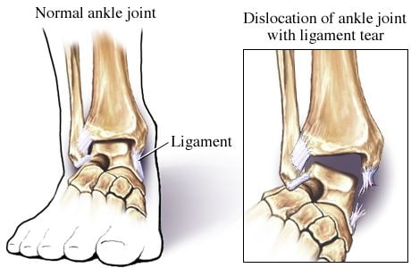 ankle-dislocation