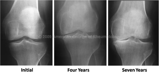 There is progressive loss of joint space over a seven-year period in the medial tibiofemoral compartment.