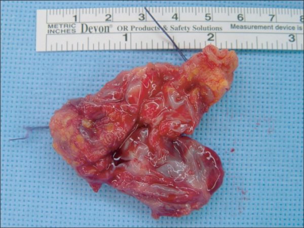 the-excised-bakers-cyst-is-shown