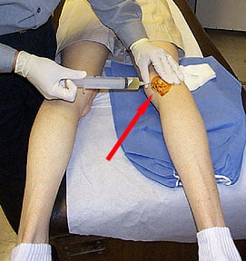bakers-cyst-knee-i6